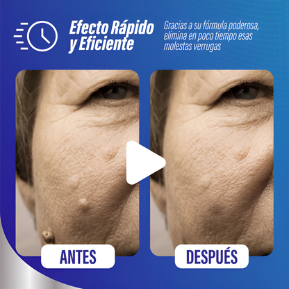 AntiWart™ Crema Remueve Verrugas